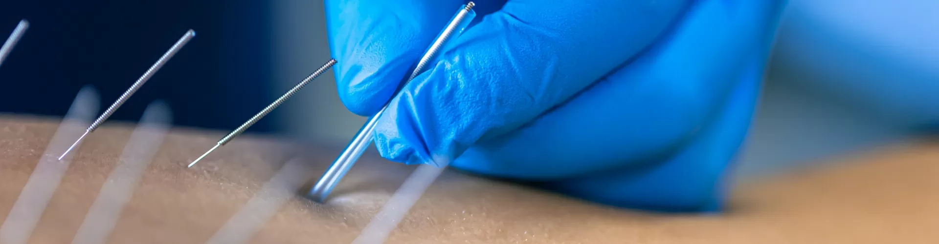 Dry Needling