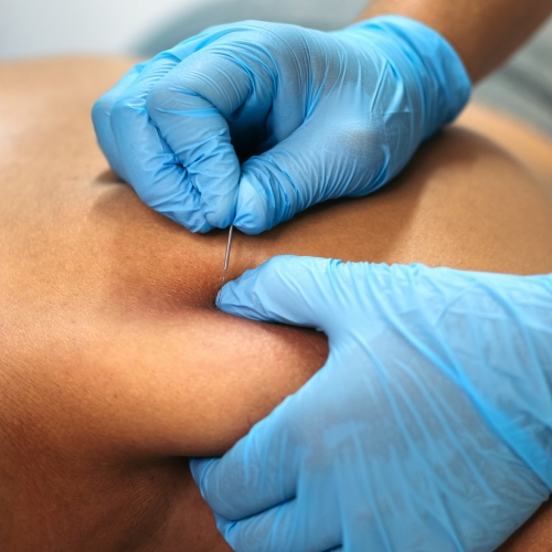 dry-needling-Salmon-Bay-Physical-Therapy-North-Gate-Ballard-Bridge-North-Ballard-Seattle-WA